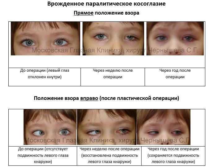 Ортоптические упражнения: мифы и реальность