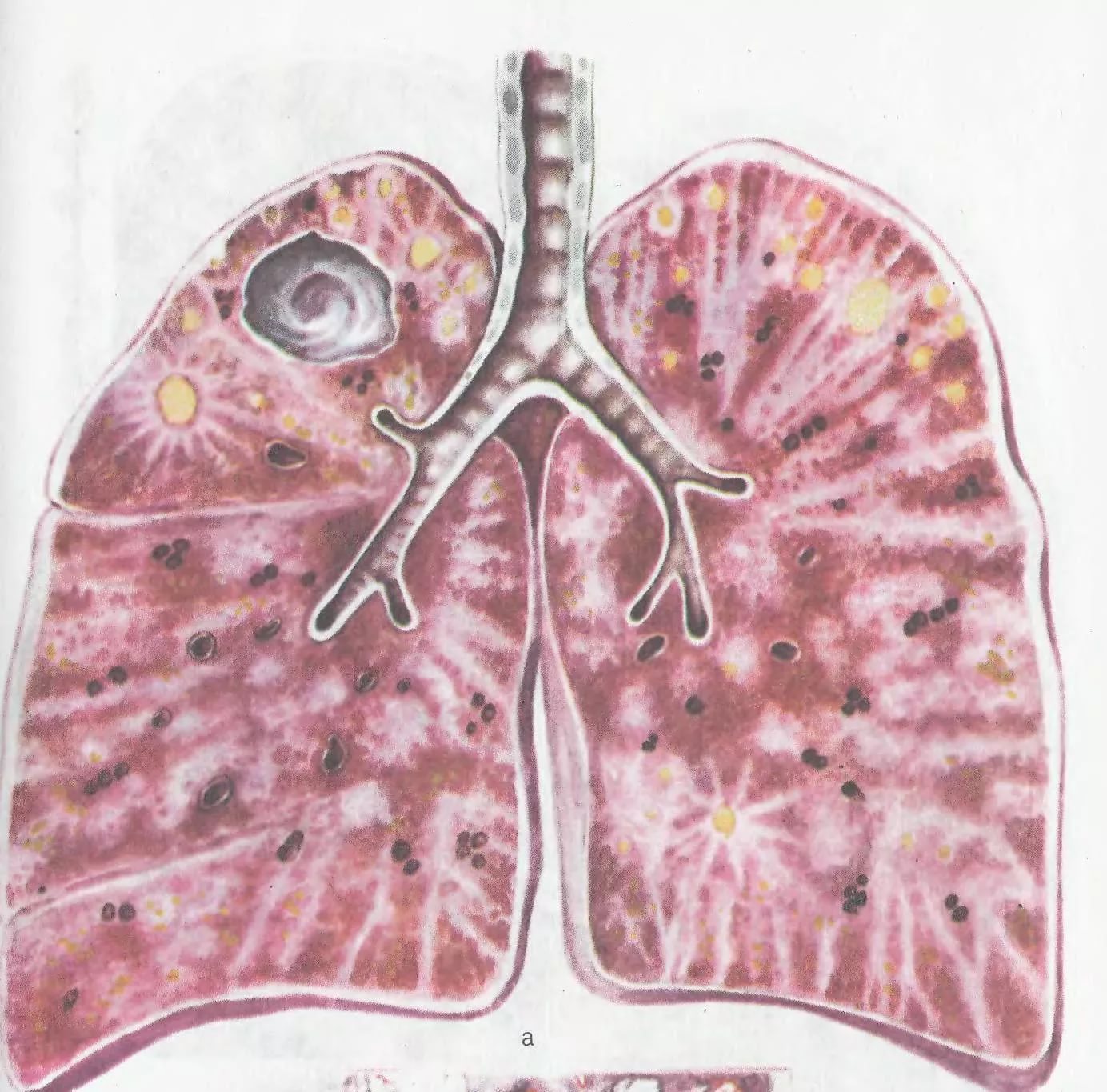 туберкулез легких картинки
