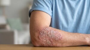 Почему стресс может сопровождаться обострением псориаза